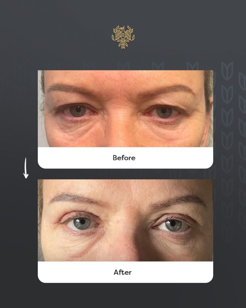 Upper Eyelid Lift Before and After with Dr. Sof