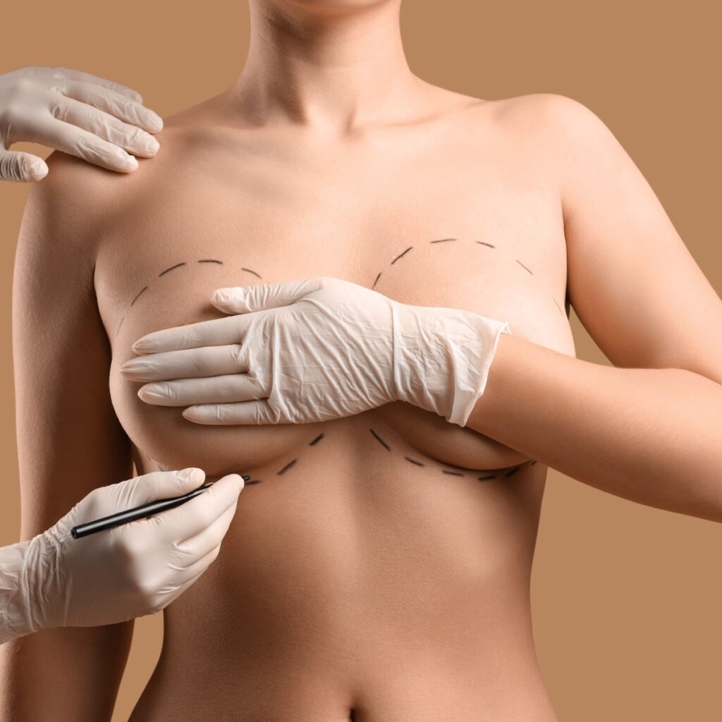 Motiva Preserve Breast Preservation Surgery with Dr. Sof in Cheshire
